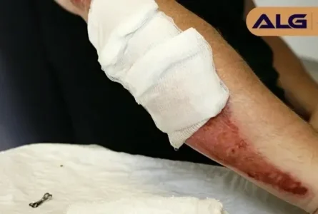 Obtaining Compensation for Road Rash Injuries from Motorcycle Accidents
